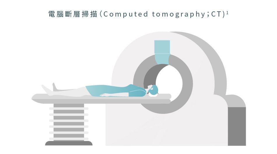 電腦斷層掃描 (CT) 有助監測大腸癌狀況