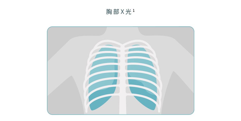 胸部X光有助檢查大腸癌有否擴散到肺部