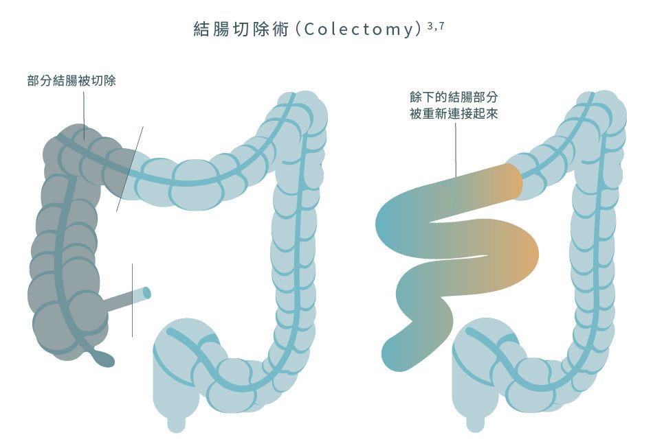 結腸切除術 (Colectomy) 原理和用途