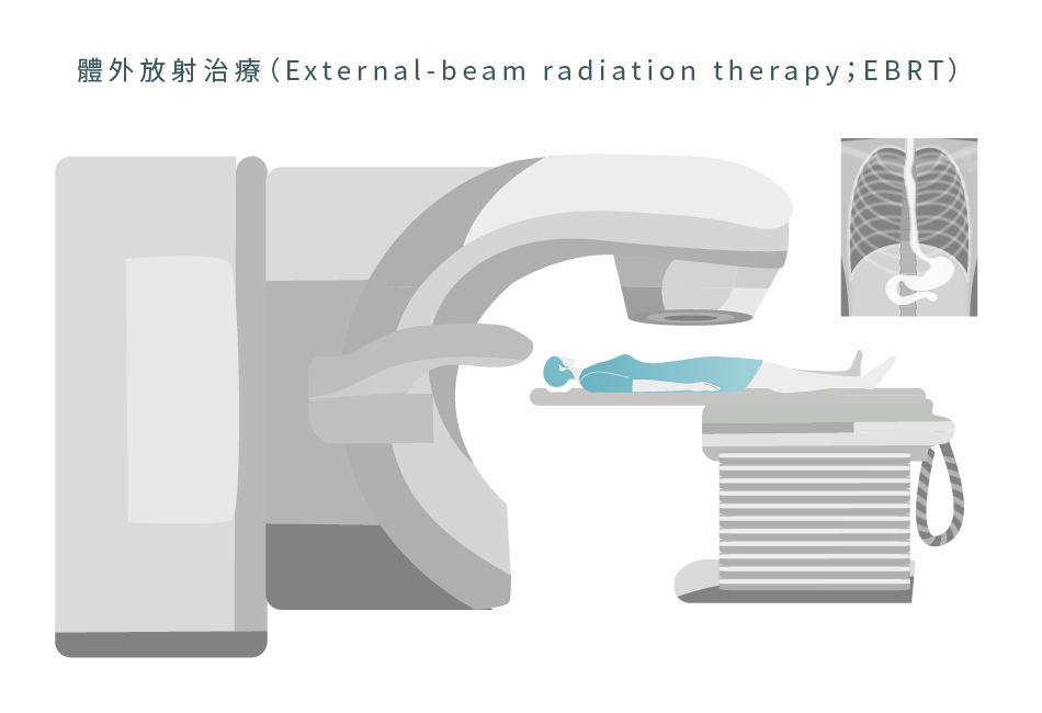 體外放射治療 (EBRT) 有助治療有肺部或肝臟擴散的大腸癌