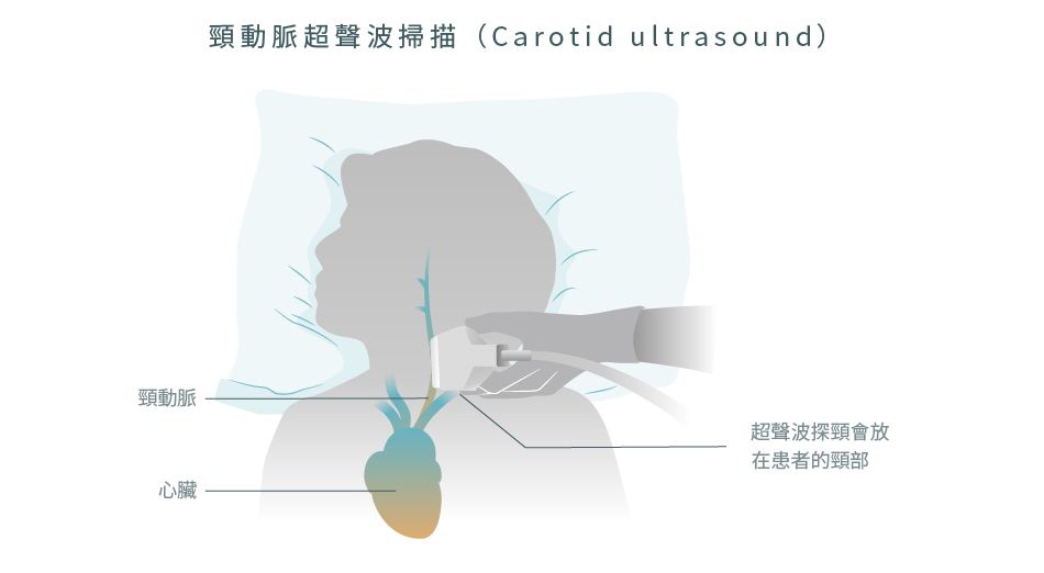 頸動脈超聲波掃描 (Carotid ultrasound) 的操作