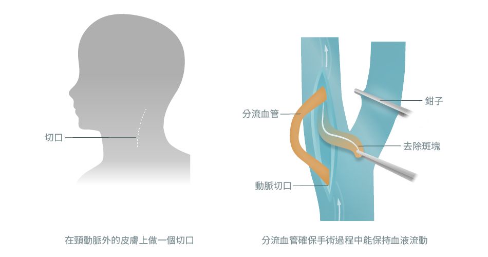 頸動脈內膜切除手術的原理和用途